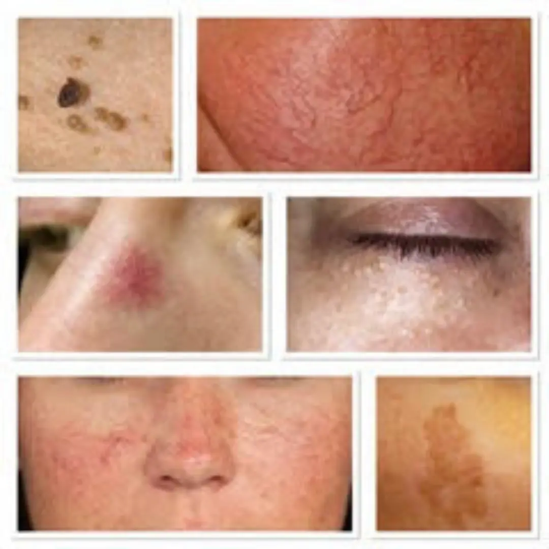 KTP Couperose Laser