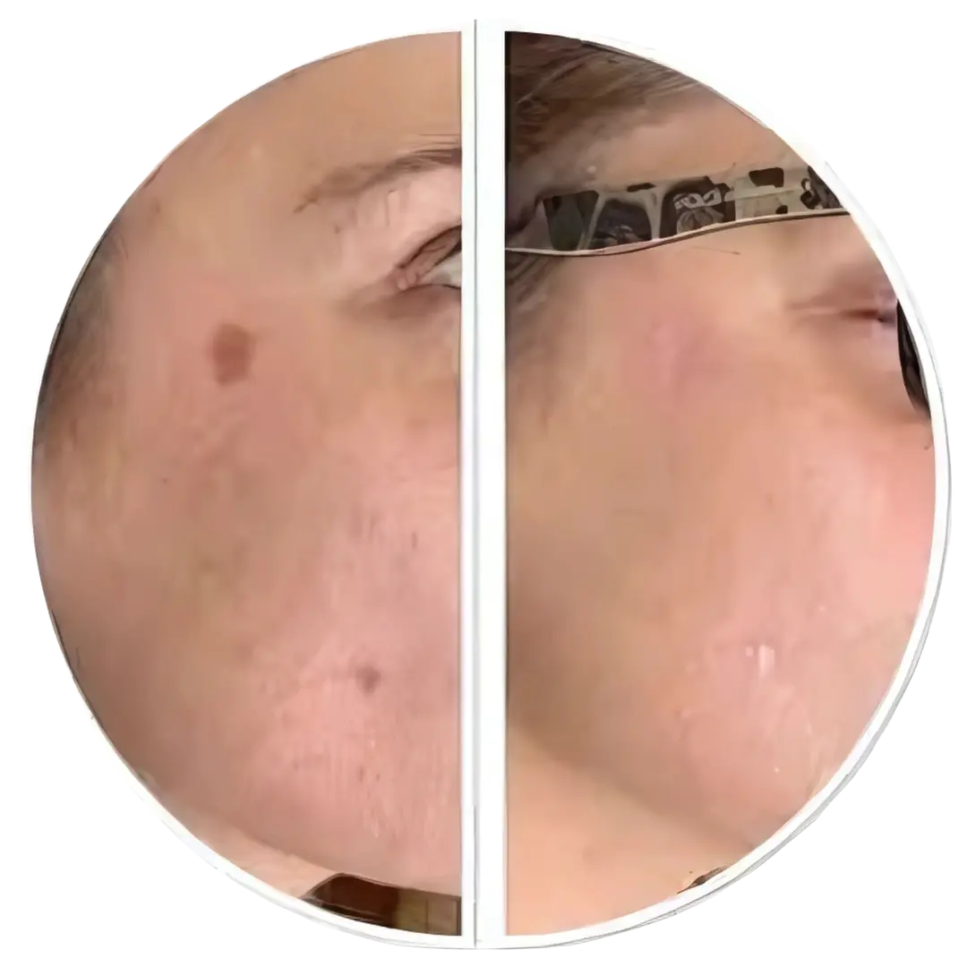 KTP couperose laser | Before & after